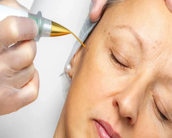 Mature woman having electrocogulation