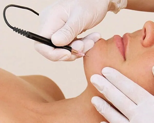 close up of woman's face getting beauty treatment