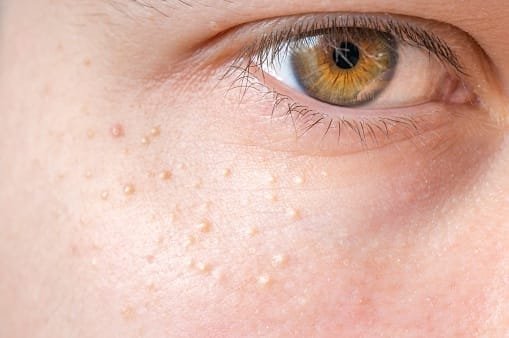 Belle Ange Beauty Services Ajax close up of pimples around eye on skin