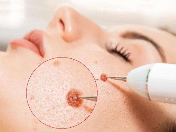 Belle Ange Beauty Services Ajax Electrocoagulation and laser cosmelotogy. Dermatologist using a professional electrocautery for removing mole. Zoomed area of melanoma