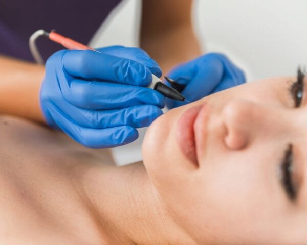 Belle Ange Health Services - Electroepilation treatment